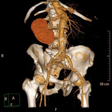CT-Angiographie der Aorta (Aneurysma)