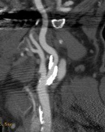 CT-Angiographie einer Einengung der Halsschlagader