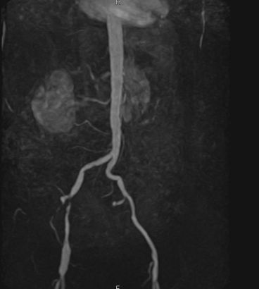 MR-Angiographie mit einer hochgradigen Einengung der Beckenschlagader rechts